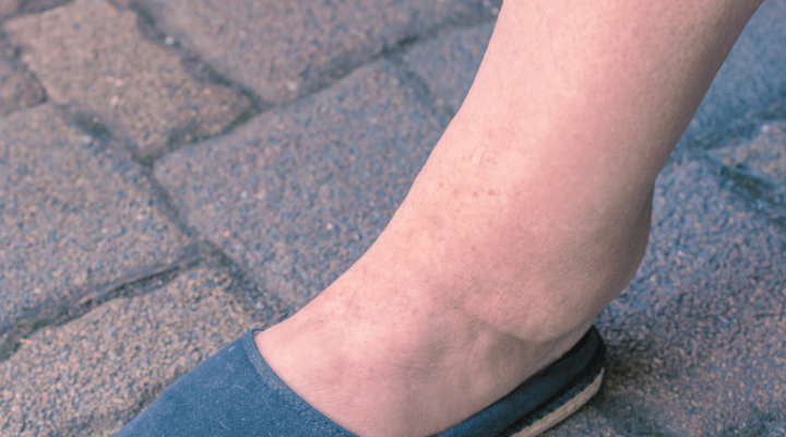 6 Causes of Water Retention and How to Reverse It