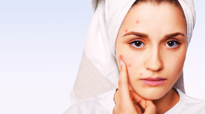 How to Remove Blackheads Naturally